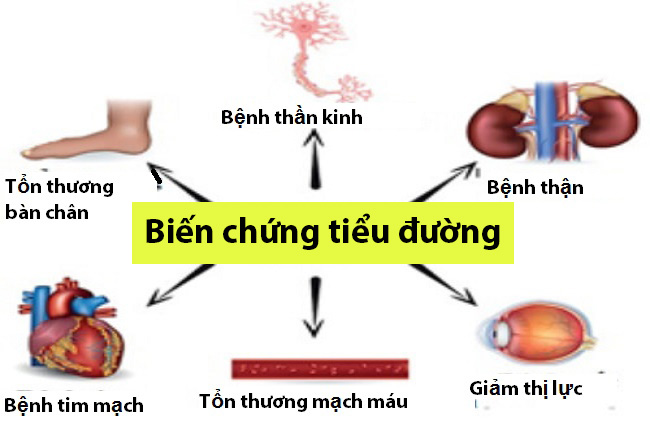 Biến chứng về thần kinh thường gặp ở người bị đái tháo đường