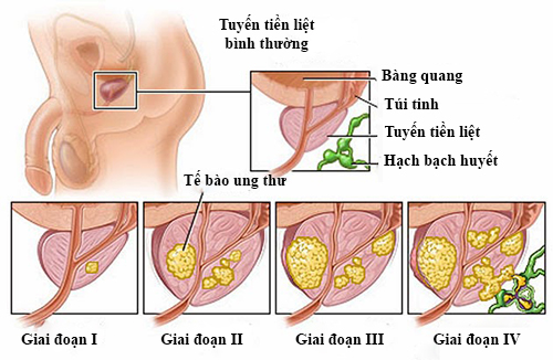 Bệnh ung thư hay u xơ tuyến tiền liệt