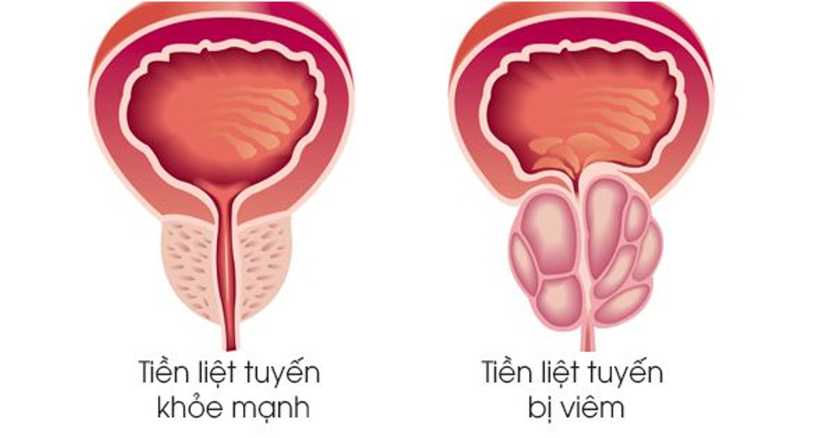 Tìm hiểu về tuyến tiền liệt (tiền liệt tuyến)