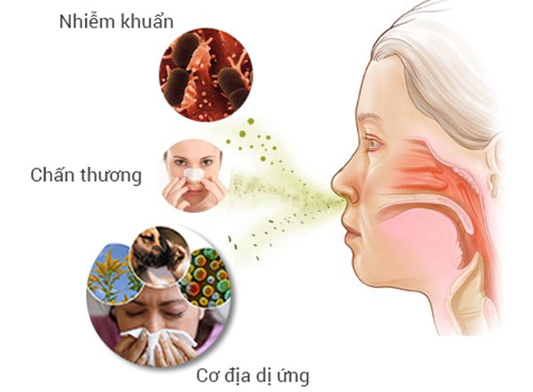 Tìm hiểu về bệnh viêm mũi dị ứng và các biến chứng của bệnh